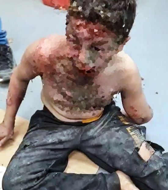 طفل فلسطيني تعرض للحرق (3)