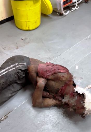 حروق بشعة في جسد طفل فلسطيني
