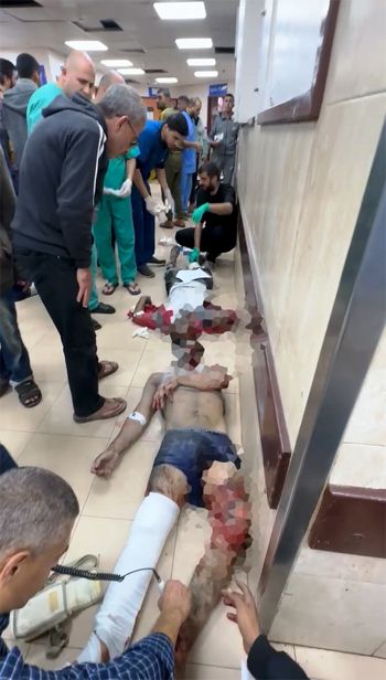 الحروق منتشرة في أجساد أطفال فلسطين بسبب الاسلحة الاسرائيلية المحرمة دوليا